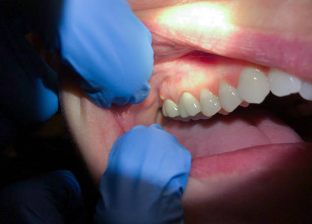 Best Emergency Dental Care for Broken or Chipped Teeth in Grandview Heights, OH